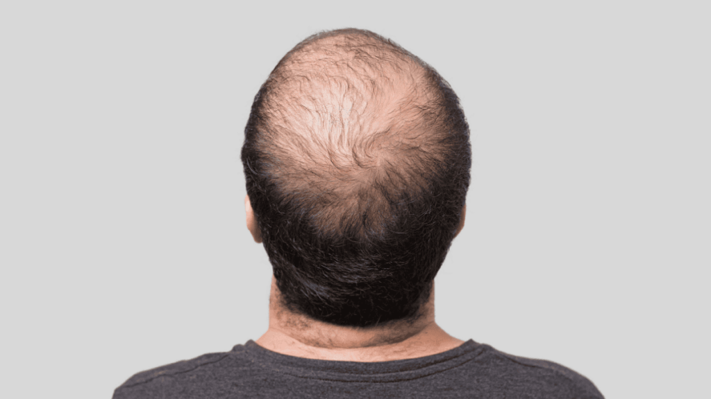 alopecia